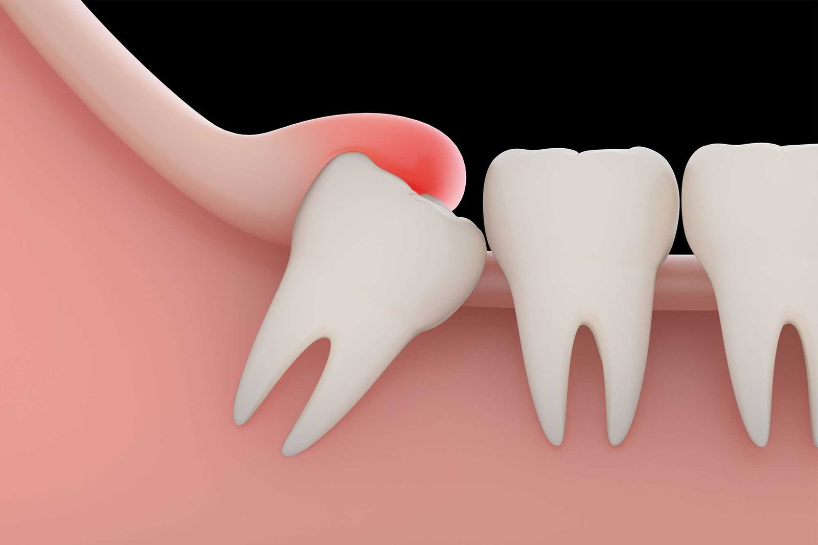 Wisdom tooth treatment